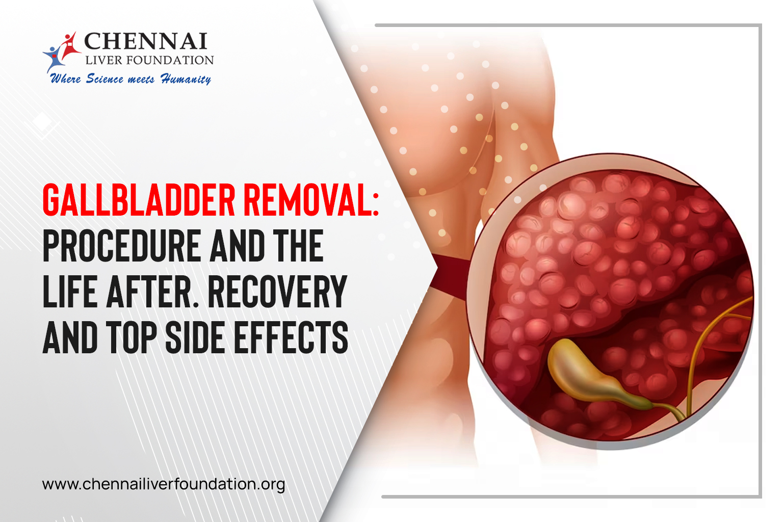 Gallbladder removal: procedure and the life after. Recovery and top side effects - Chennai Liver Foundation
