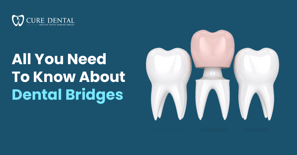 All You Need to Know About Dental Bridges | Cure Dental