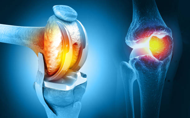 Myths About Knee Replacement Surgery