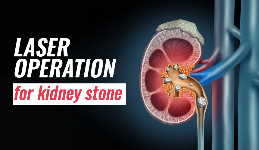 Laser Operation for Kidney Stone | World of Urology