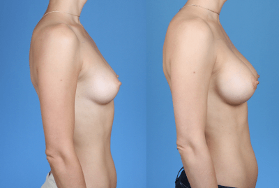 Breast Augmentation – Plastic Surgeon Dr. Brian | Newport Beach, CA