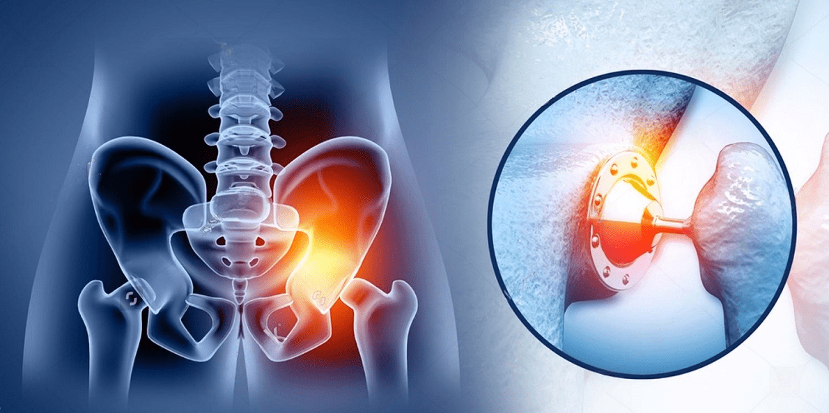 Understanding Total Hip Replacement: A Comprehensive Guide