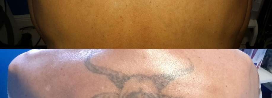 Winter Park Tattoo Removal Cover Image