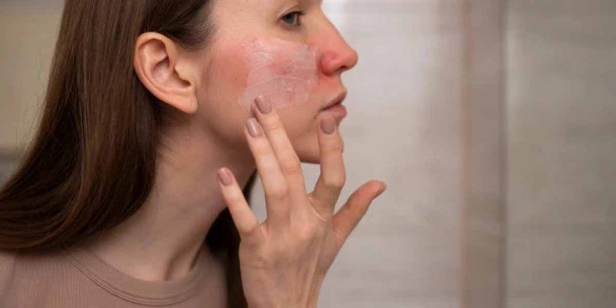Which Acne Scar Treatment Is Best for Your Skin Type?