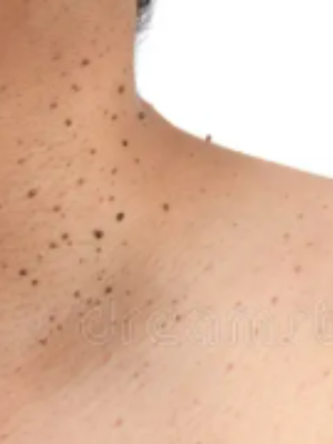 Professional Skin Treatment in Buckingham | Consult Now