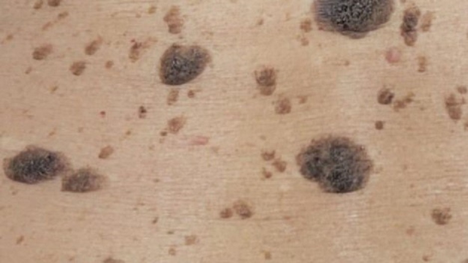 How to Get Rid of Seborrheic Keratosis: A Treatment Guide