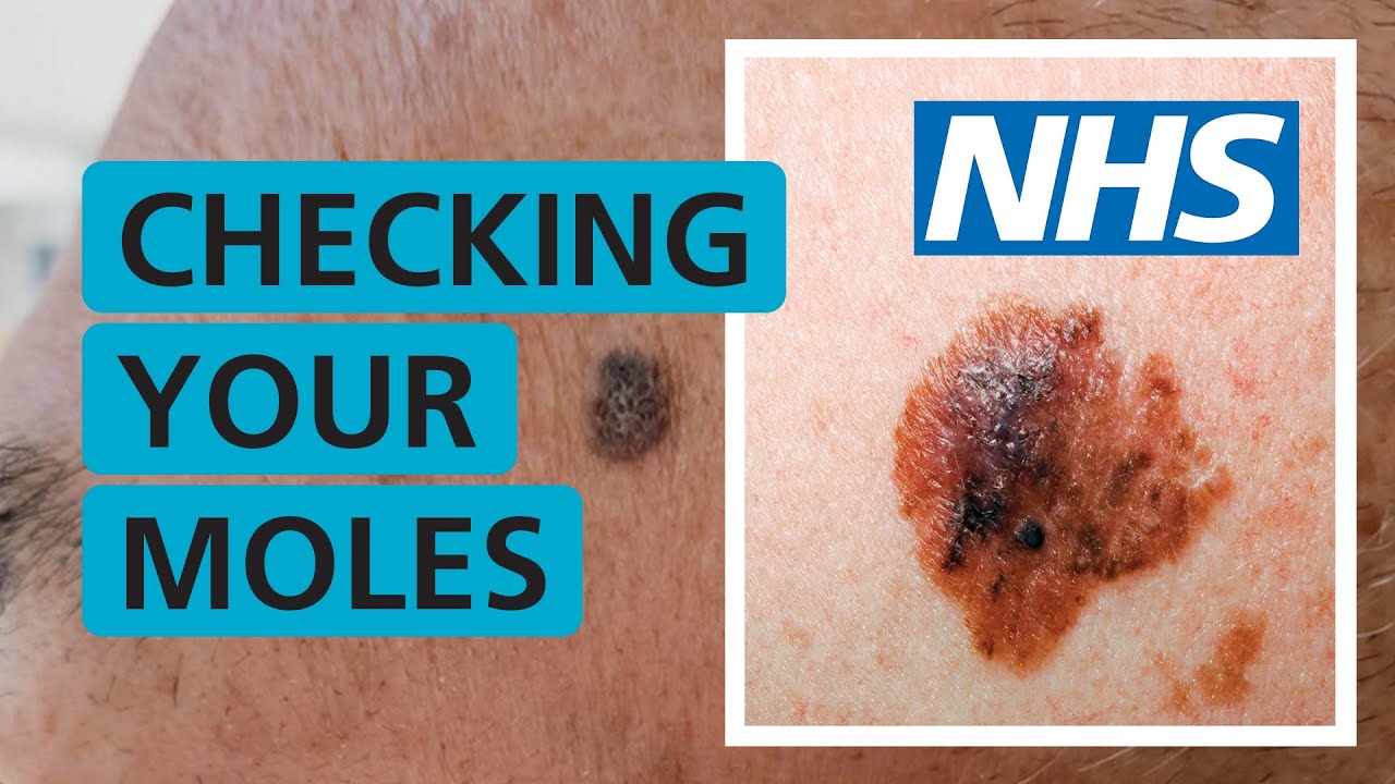 How to Check Moles for Skin Cancer | NHS-Aligned Guide