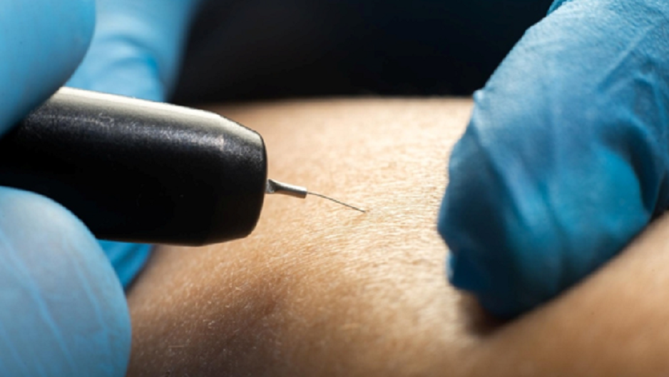 Electrolysis Hair Removal Cost UK: A Complete Price Guide