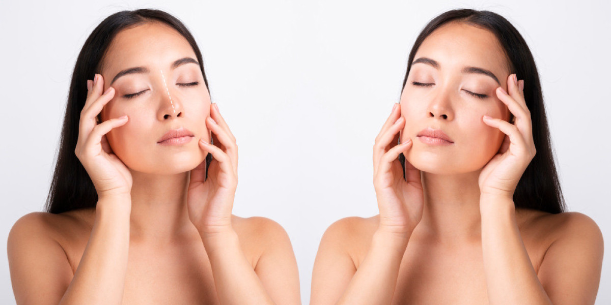 Best Non-Surgical Face Lift Treatment: HIFU vs Thread Lift