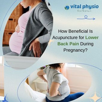 How Beneficial Is Acupuncture for Lower Back Pain During Pregnancy?