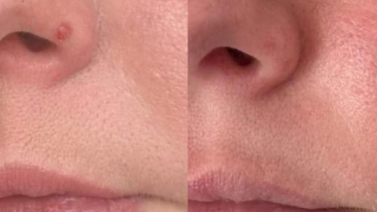 What Factors Affect Fibrous Papule Removal Costs in the UK? – ahadvancedskinspecialist