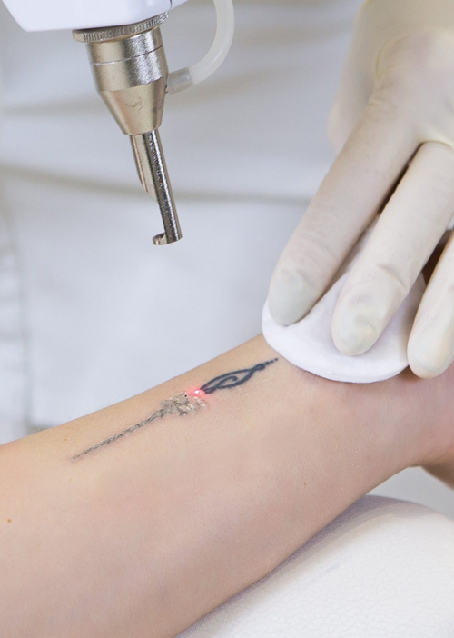Tattoo Removal Treatment Dandenong & Dandenong South