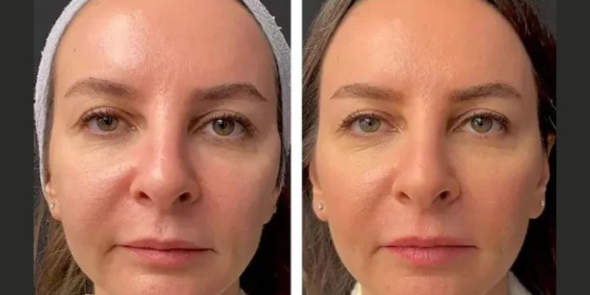 Mesotherapy in Dubai: Skin Rejuvenation Benefits