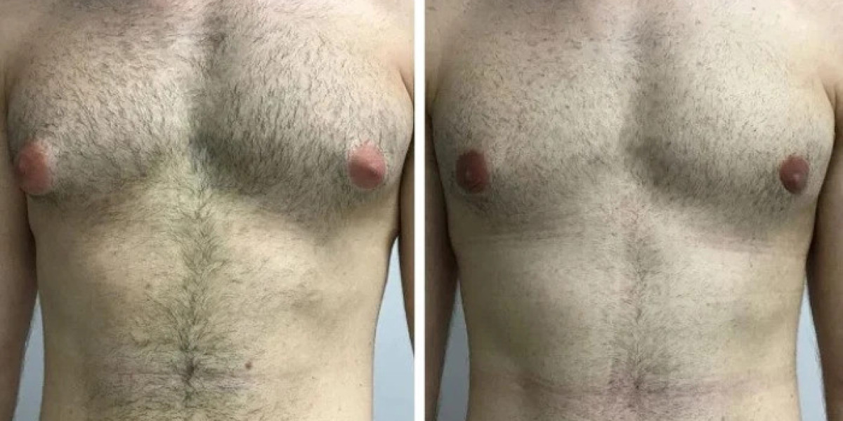 Best Gynecomastia Surgeon in dubai and Incision Placement Factors