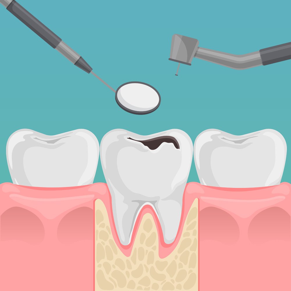 Dental Restoration Services Indirapuram - Sharda Dental Clinic