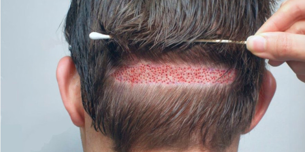 Hair Transplant in Lahore: Benefits, Risks, and Recovery