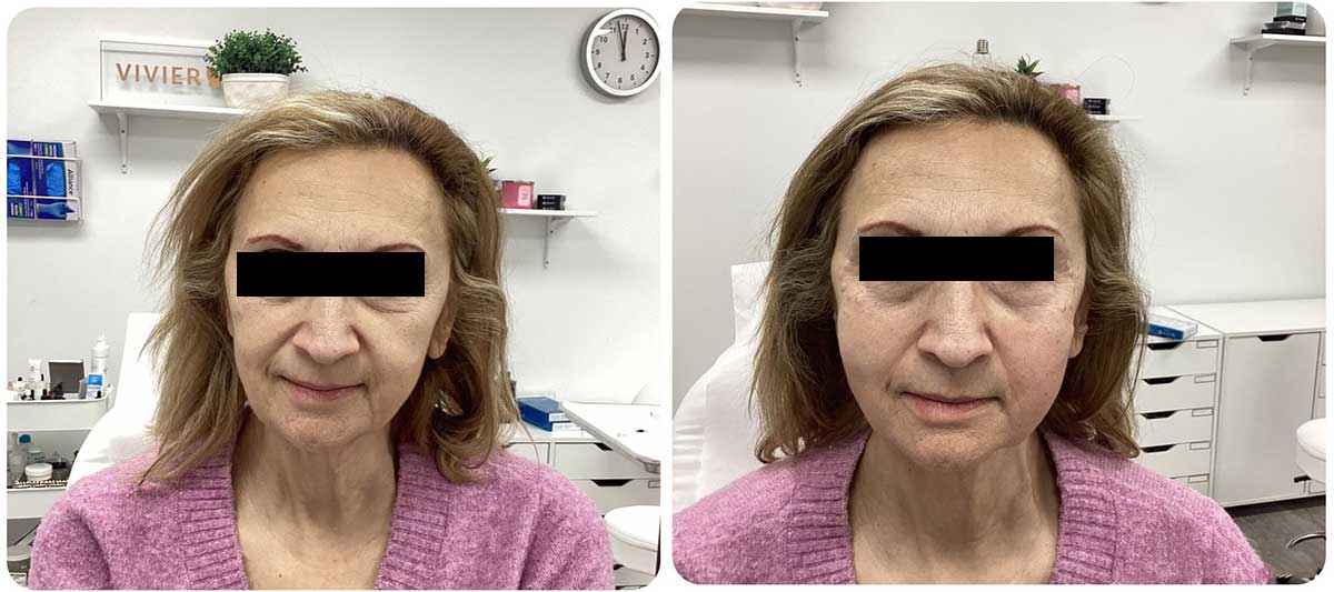 Dermal Fillers in Mississauga, ON | Glamderm Medi Spa