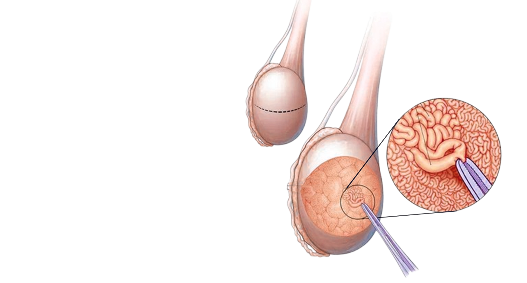 Micro TESE Treatment in Delhi NCR | Queens IVF Care