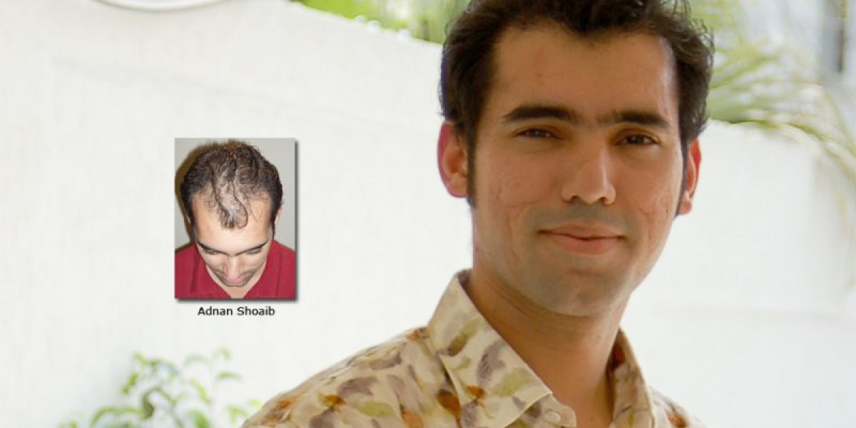 Receding Hairline in Your 20s or 30s? When Should You Consider a Hair Transplant in Lahore?